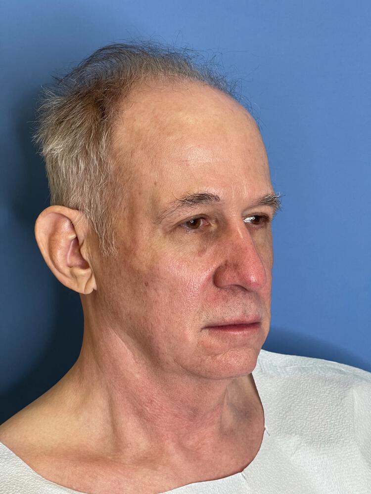 Chin Implants Before & After Image