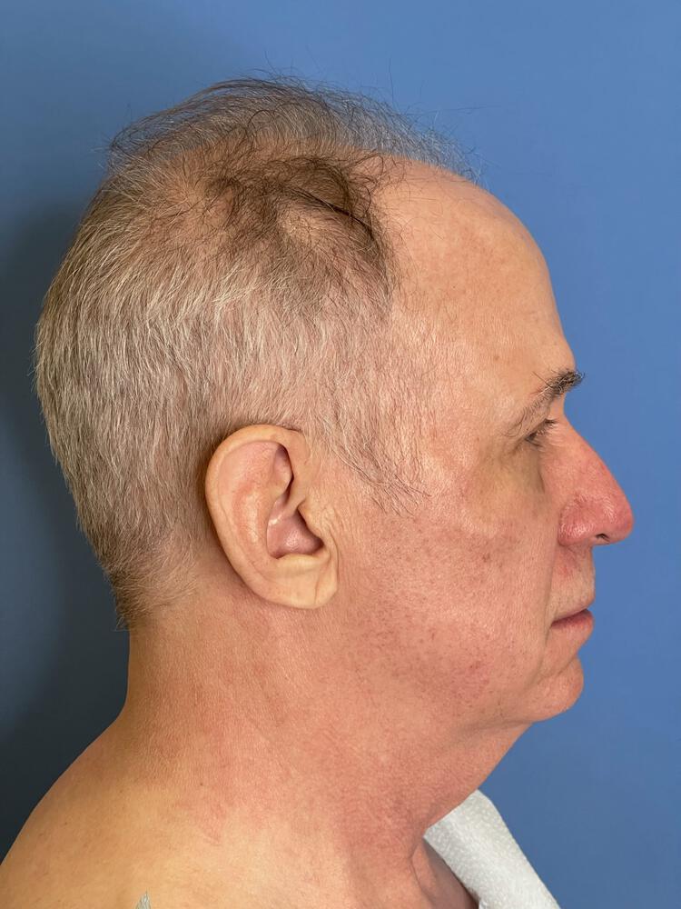 Chin Implants Before & After Image