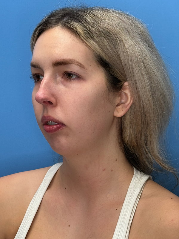 Chin Implants Before & After Image