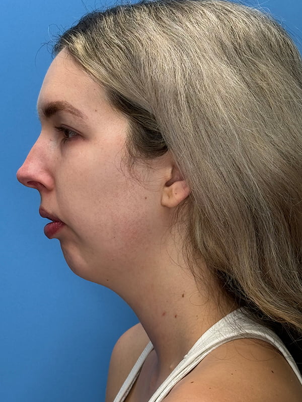 Chin Implants Before & After Image