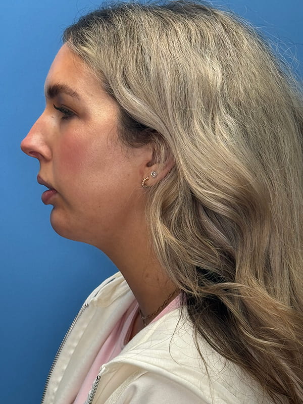 Chin Implants Before & After Image