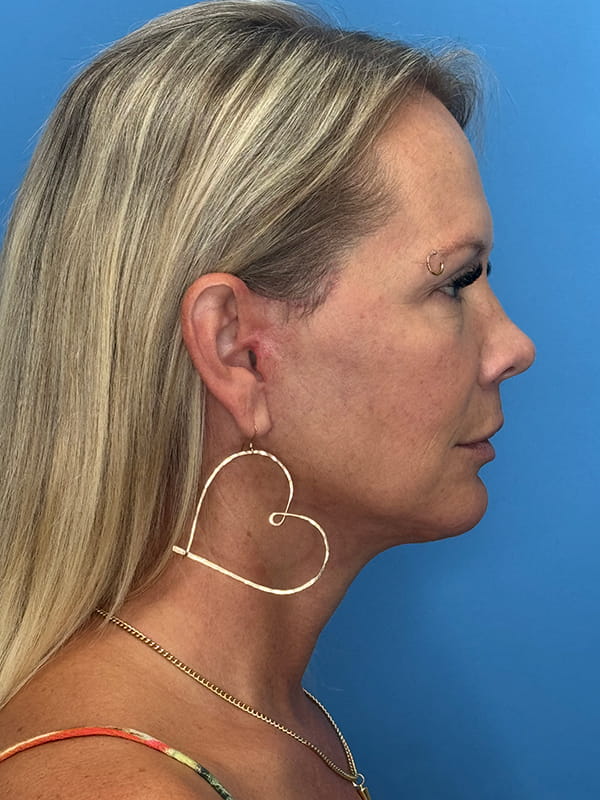 Chin Implants Before & After Image