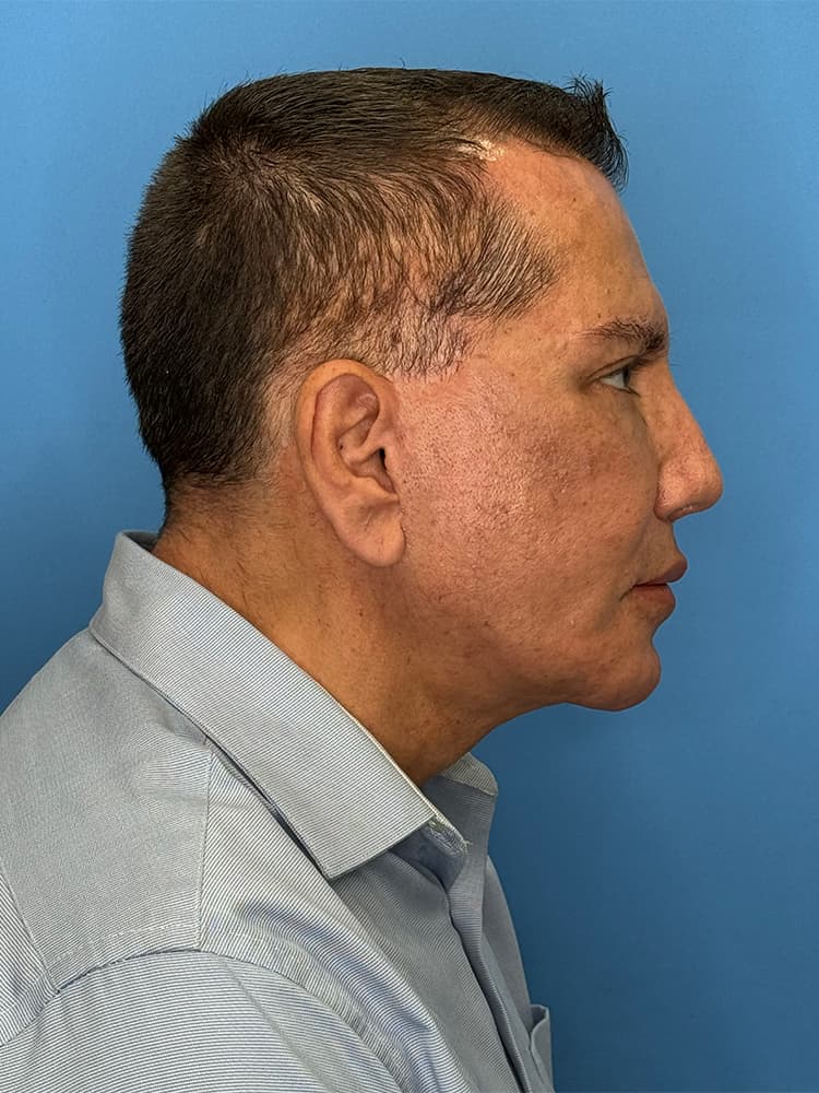 Custom Facial Implants Before & After Image