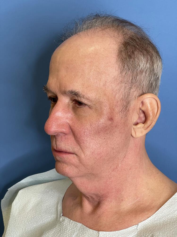 Custom Facial Implants Before & After Image