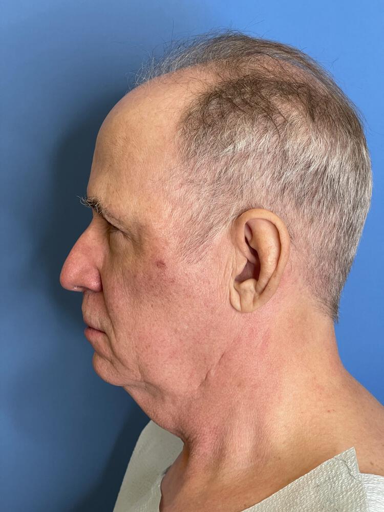 Custom Facial Implants Before & After Image