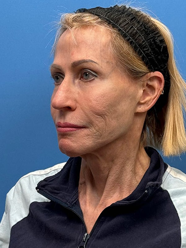 Temporal Implants Before & After Image