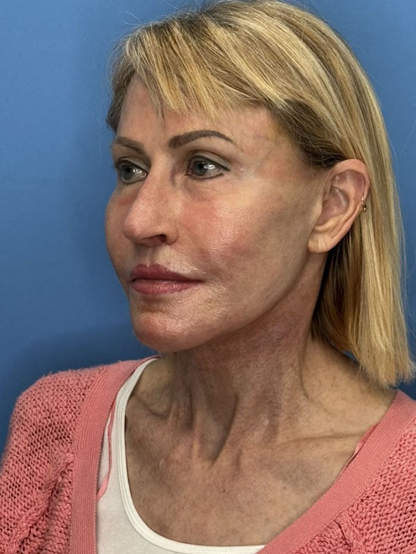 Temporal Implants Before & After Image