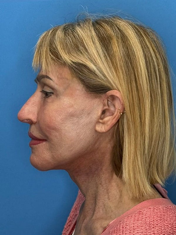 Temporal Implants Before & After Image