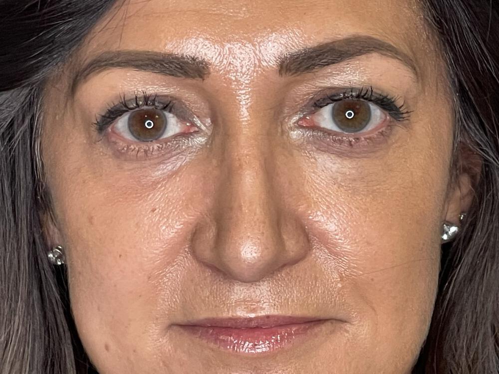 Chemical Peels Before & After Image