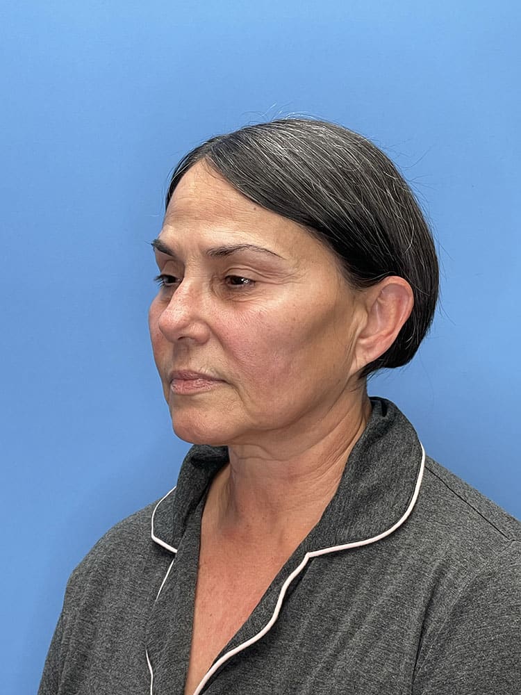Chemical Peels Before & After Image