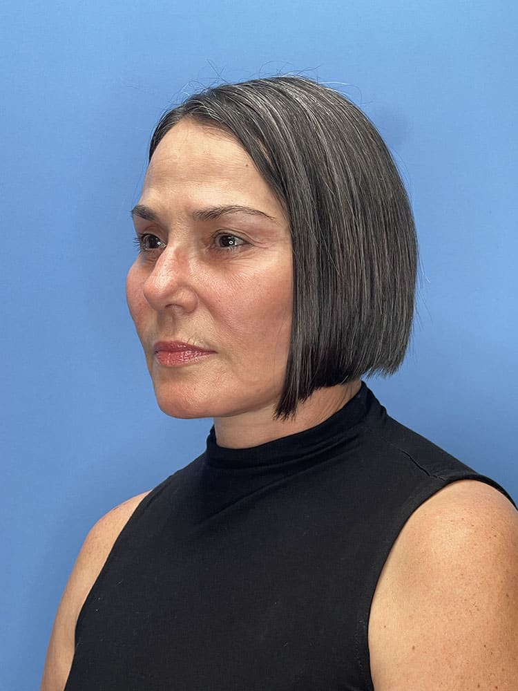Chemical Peels Before & After Image