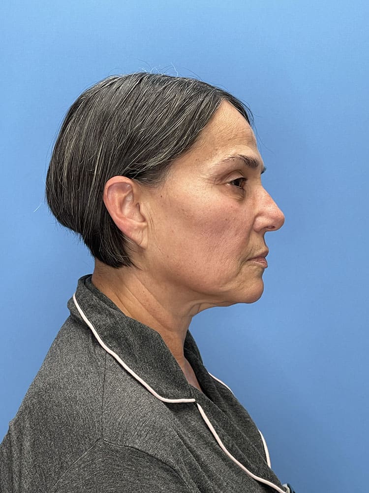 Chemical Peels Before & After Image
