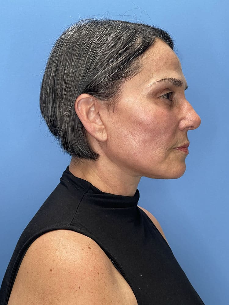 Chemical Peels Before & After Image