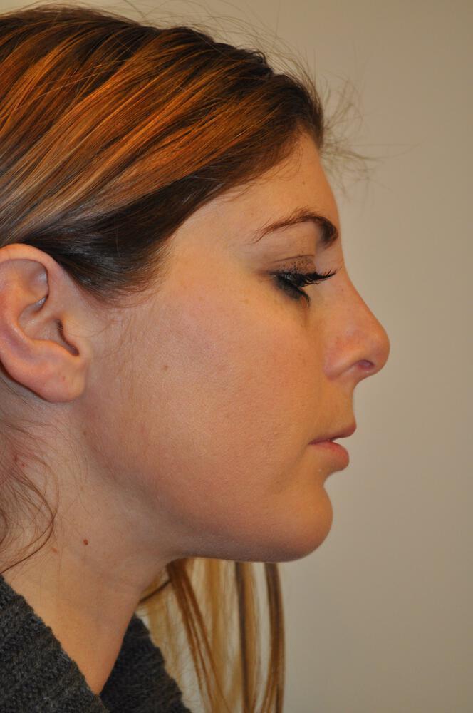 Chin Fillers Before & After Image