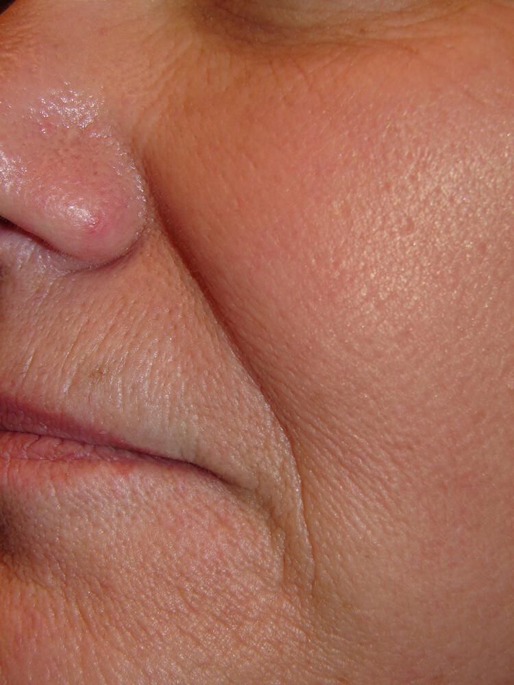 Dermal Fillers Before & After Image