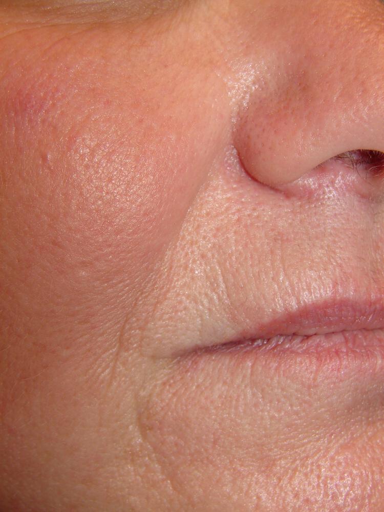 Dermal Fillers Before & After Image