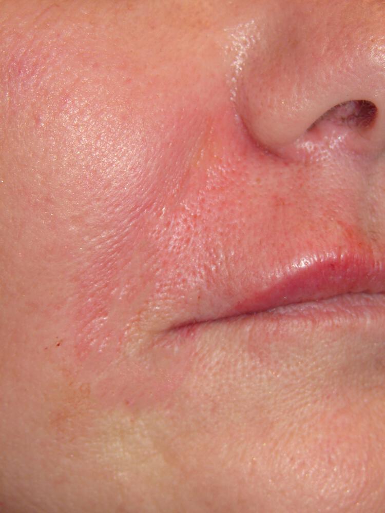 Dermal Fillers Before & After Image