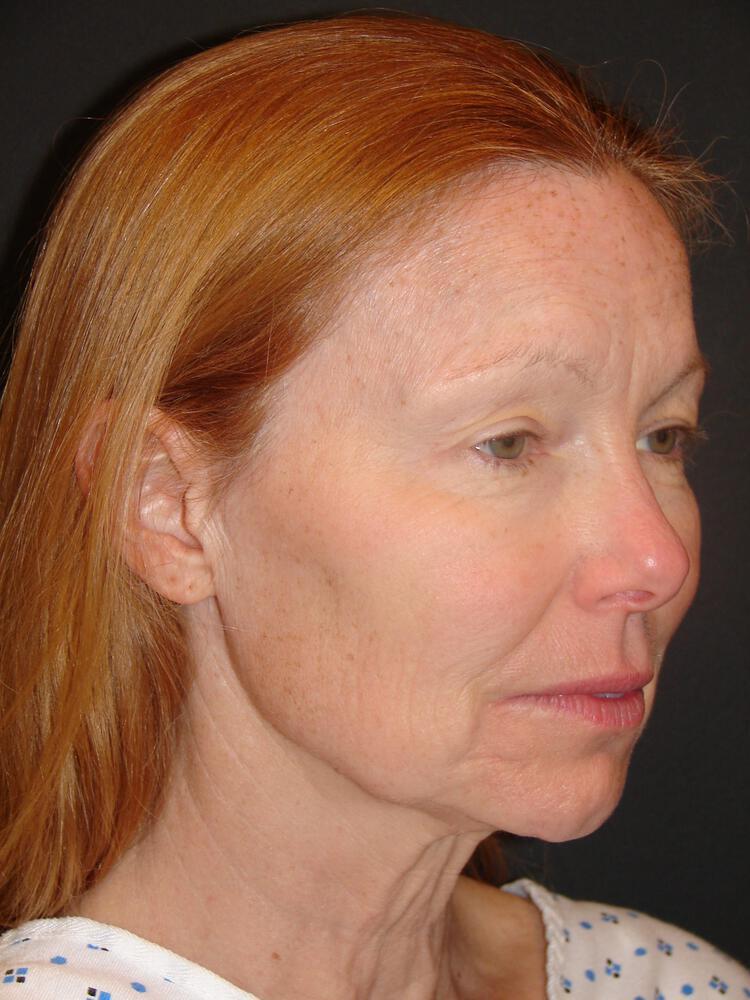Laser Skin Resurfacing Before & After Image