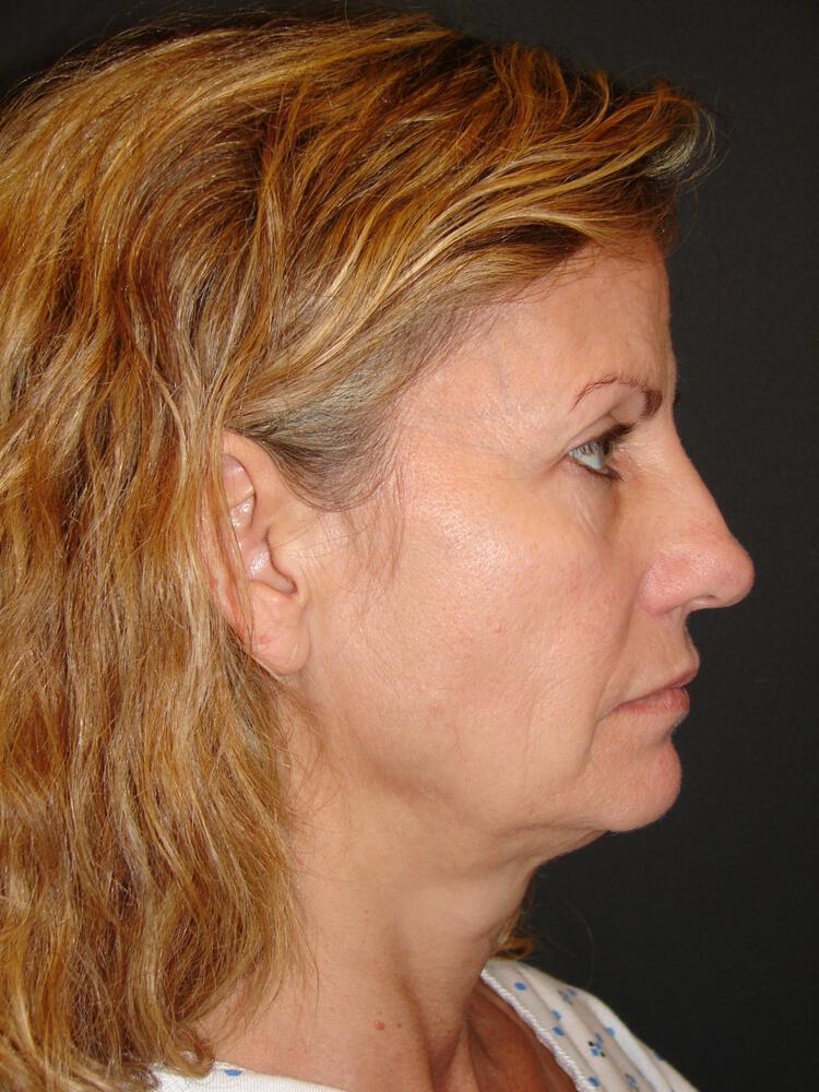 Laser Skin Resurfacing Before & After Image