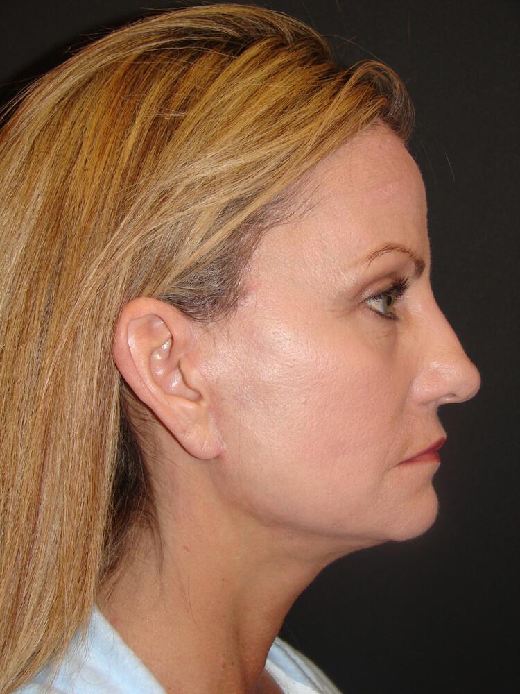 Laser Skin Resurfacing Before & After Image