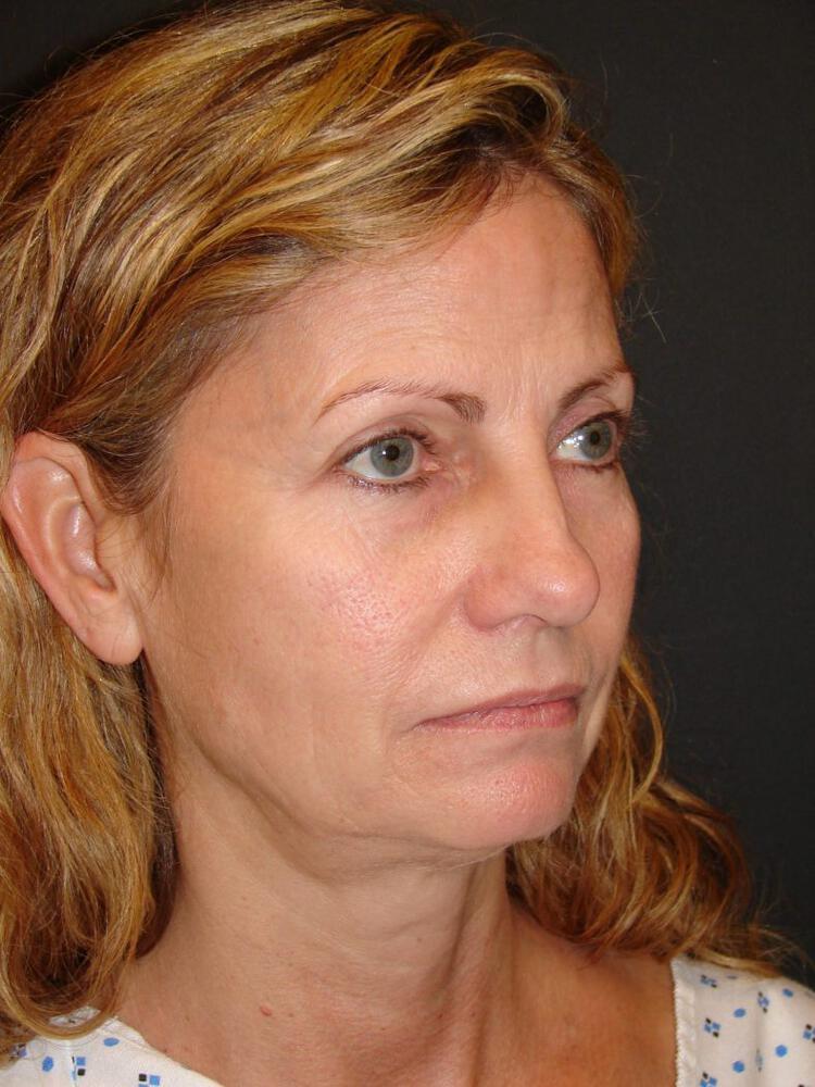 Laser Skin Resurfacing Before & After Image