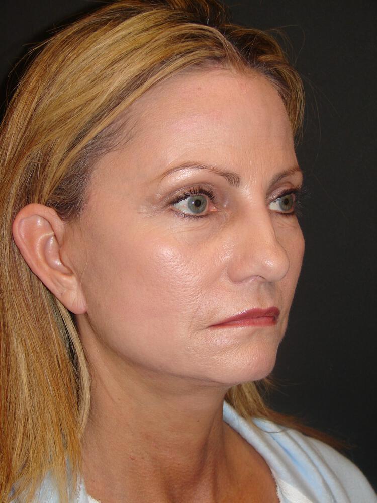 Laser Skin Resurfacing Before & After Image