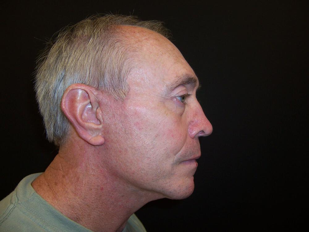 Laser Skin Resurfacing Before & After Image