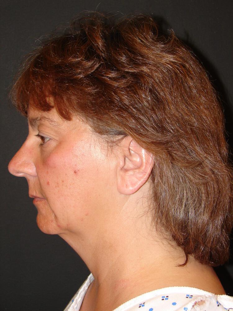 Laser Skin Resurfacing Before & After Image