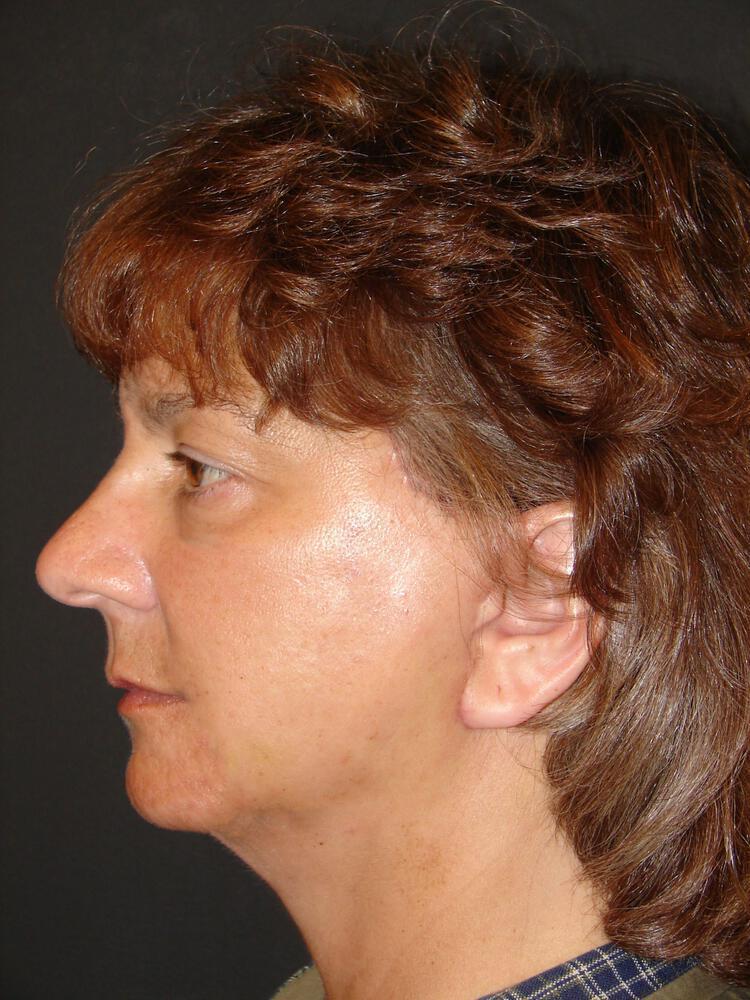 Laser Skin Resurfacing Before & After Image