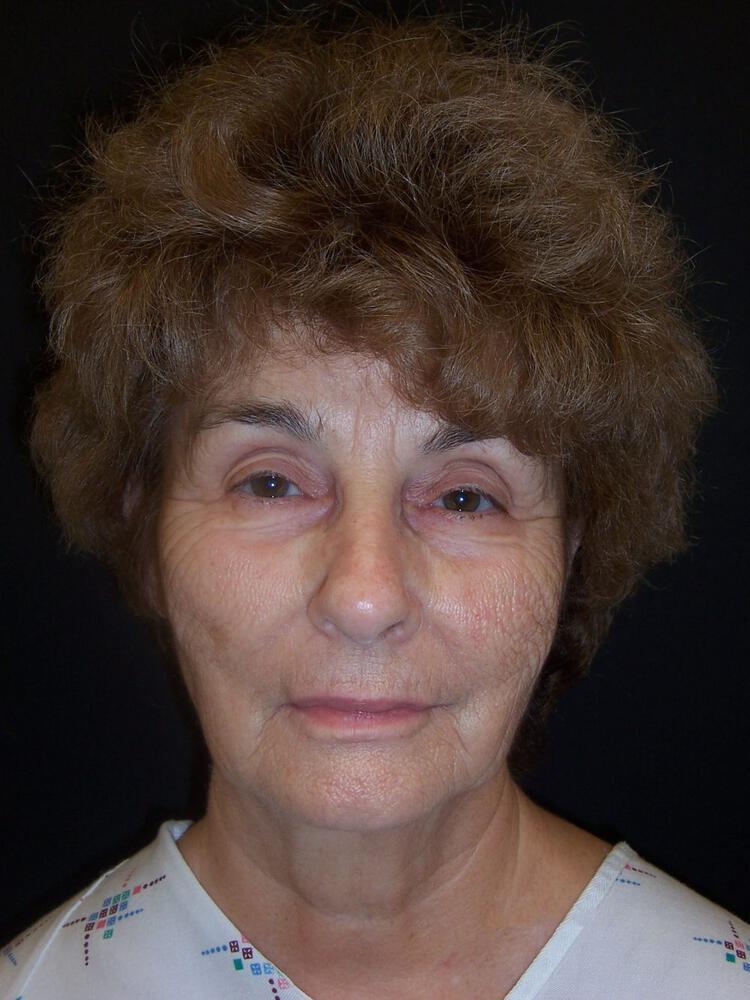 Laser Skin Resurfacing Before & After Image