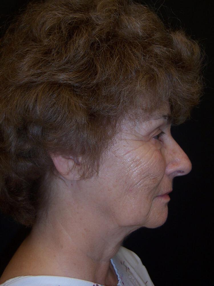 Laser Skin Resurfacing Before & After Image