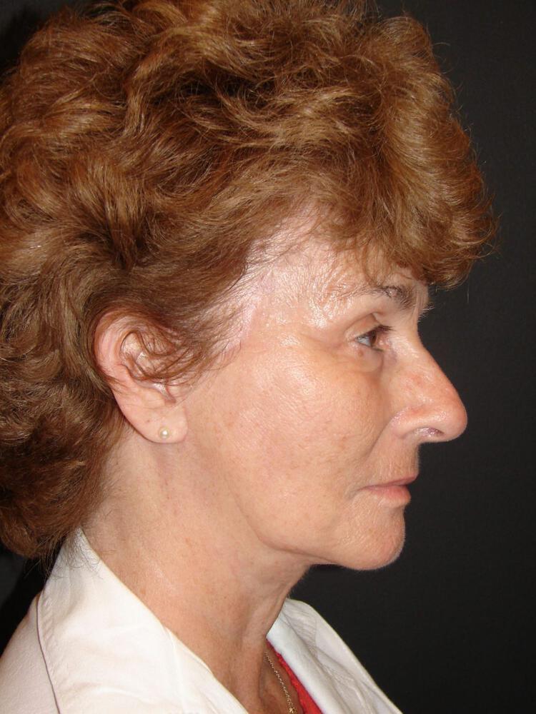 Laser Skin Resurfacing Before & After Image