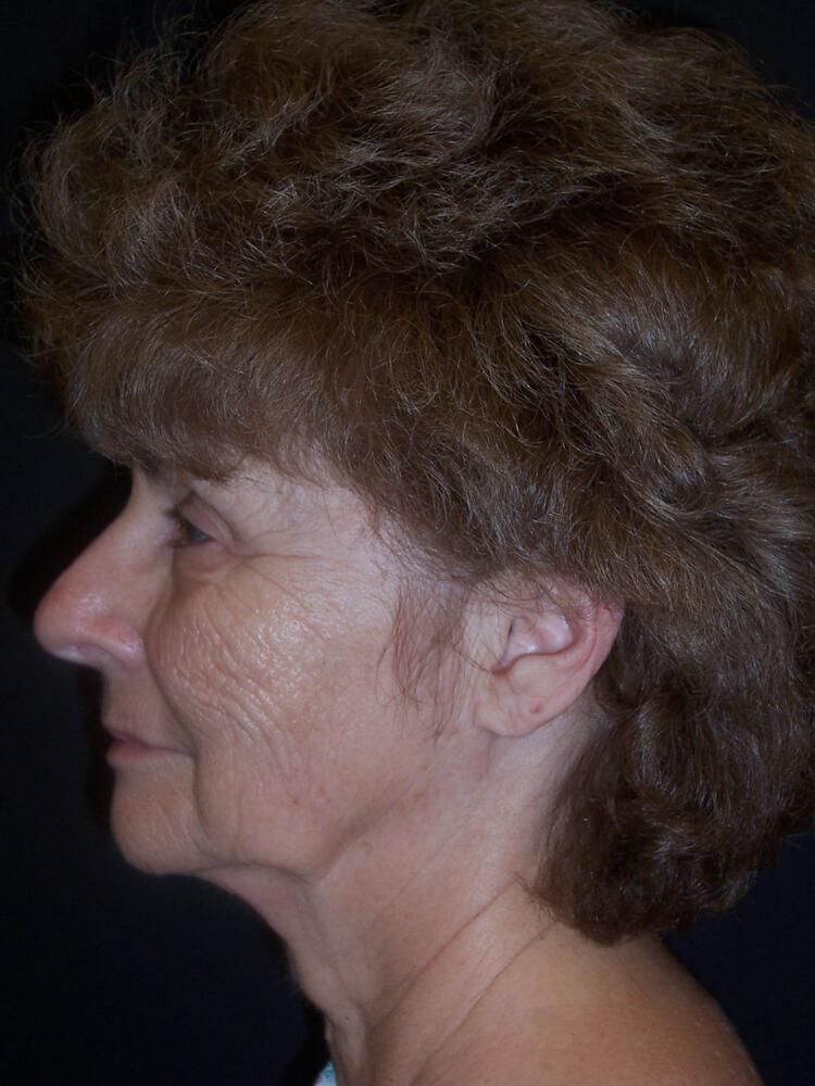 Laser Skin Resurfacing Before & After Image