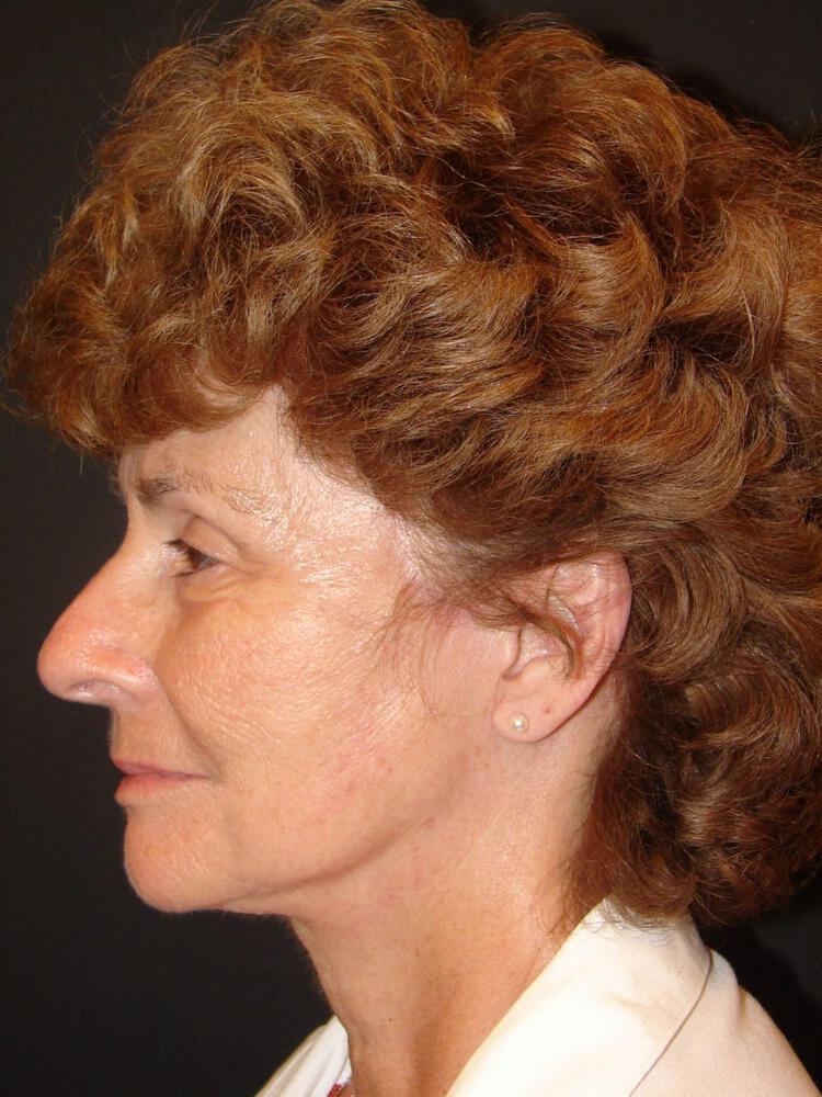 Laser Skin Resurfacing Before & After Image