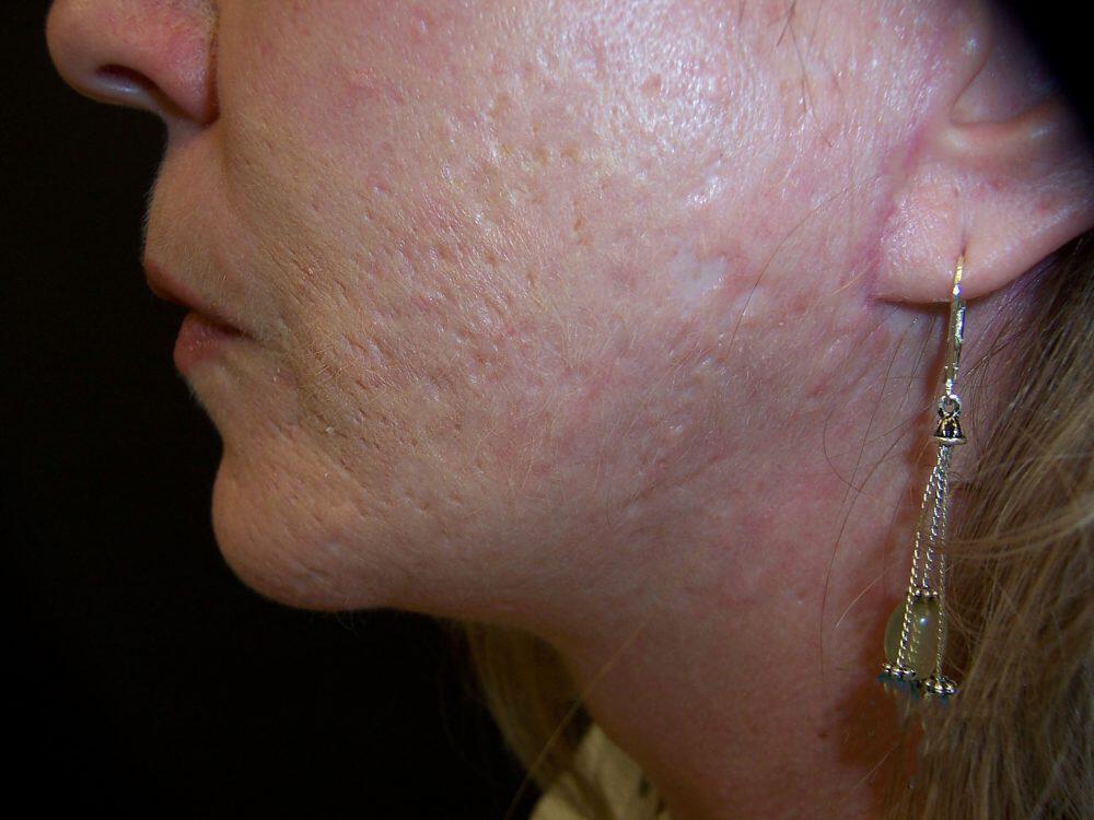 Laser Skin Resurfacing Before & After Image