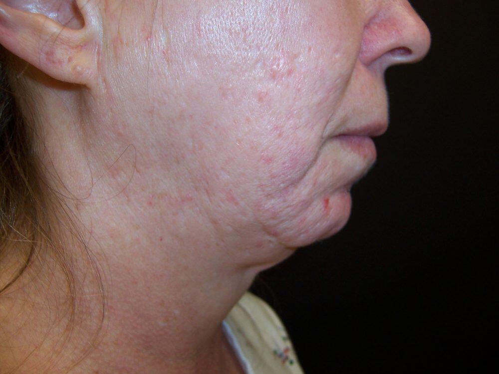 Laser Skin Resurfacing Before & After Image