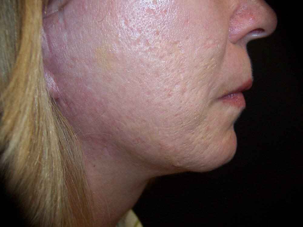 Laser Skin Resurfacing Before & After Image