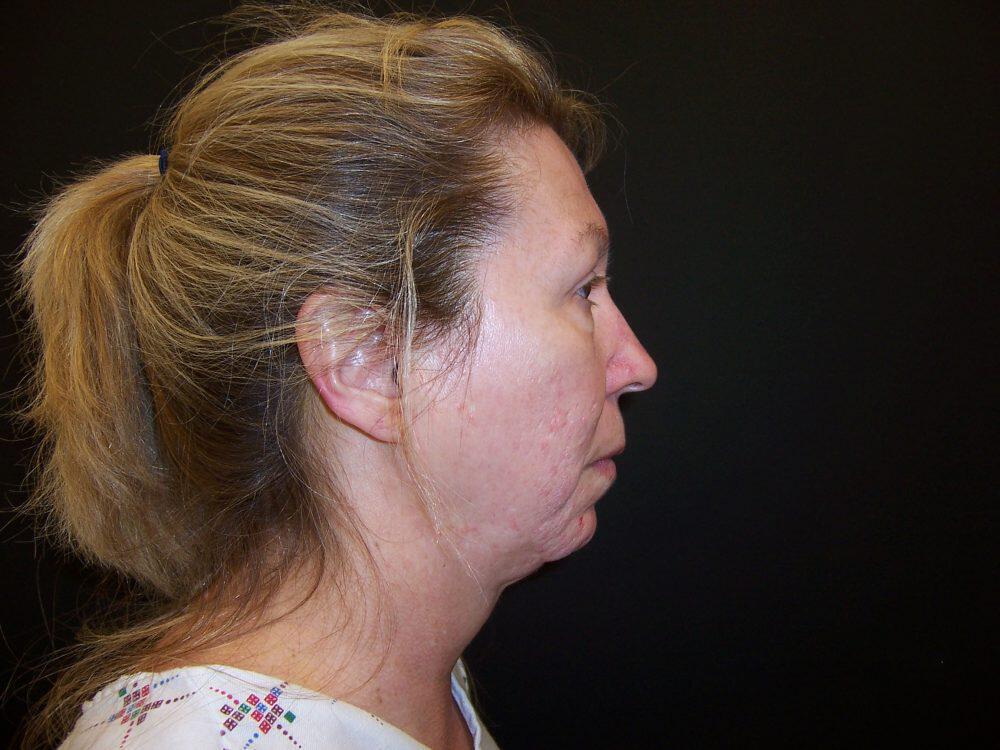 Laser Skin Resurfacing Before & After Image