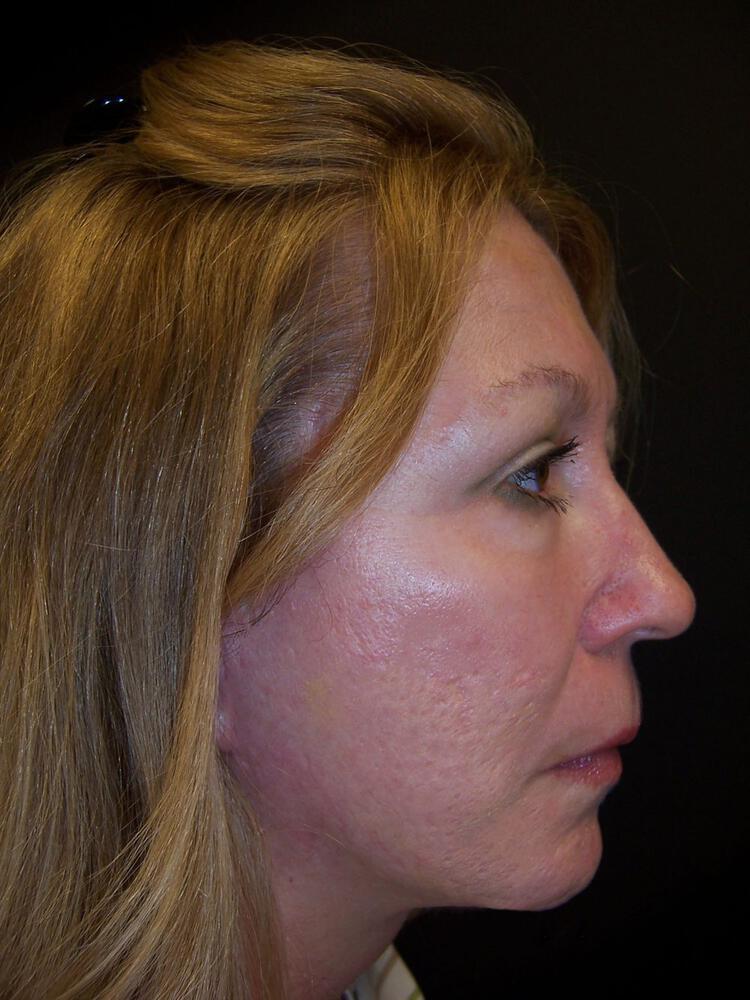 Laser Skin Resurfacing Before & After Image