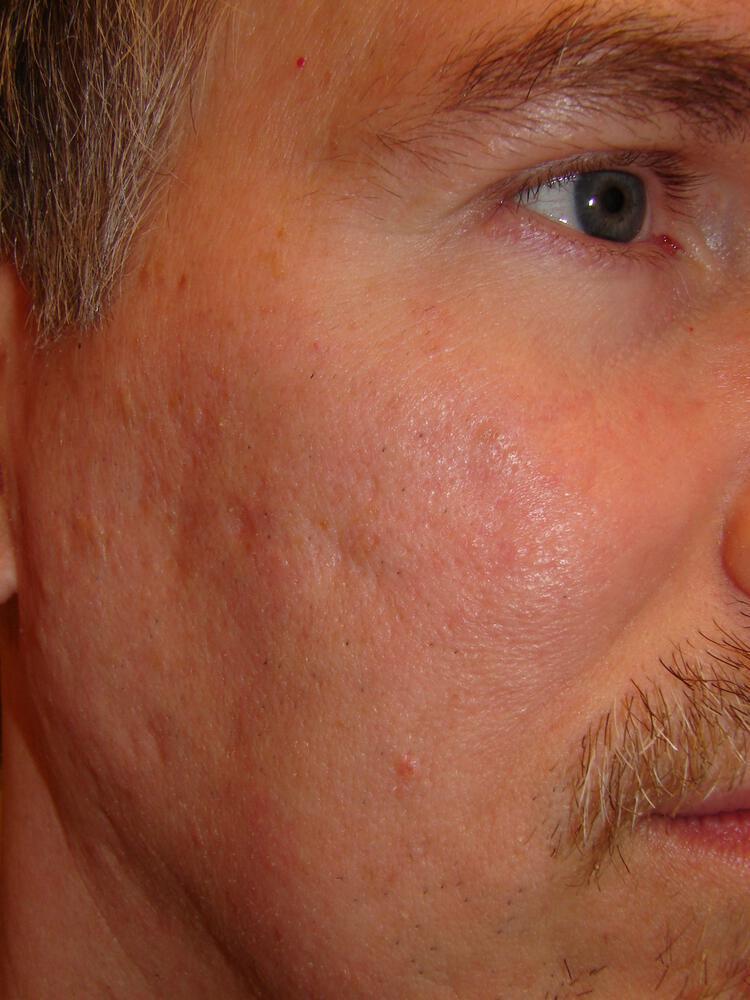 Laser Skin Resurfacing Before & After Image