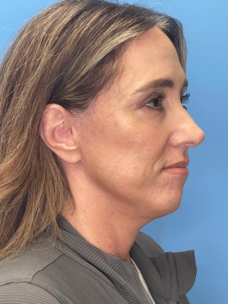 Laser Skin Resurfacing Before & After Image