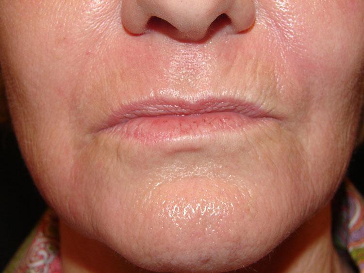 Laser Treatments Before & After Image