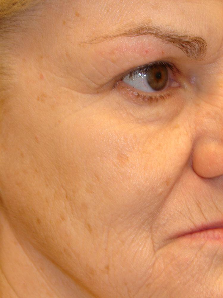 Laser Treatments Before & After Image