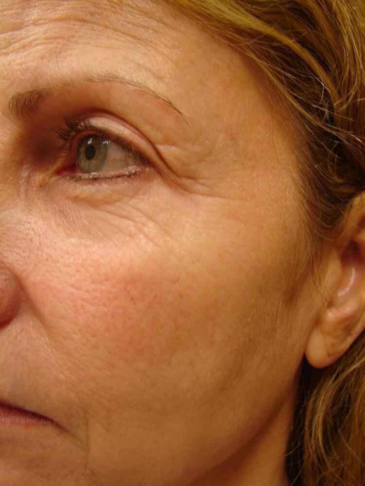 Laser Treatments Before & After Image