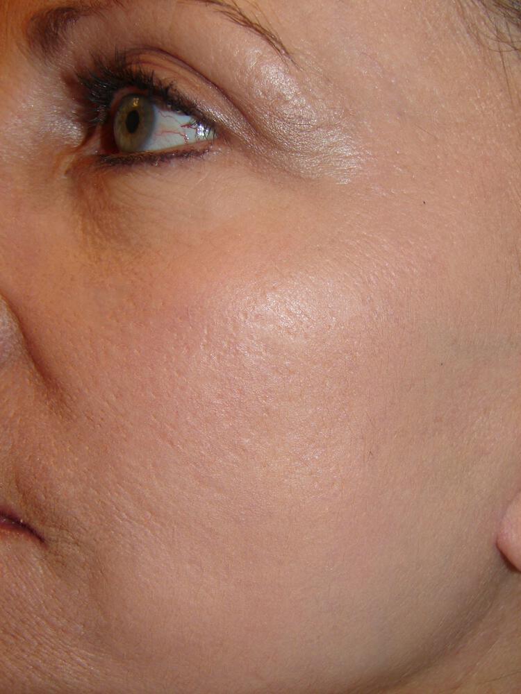 Laser Treatments Before & After Image