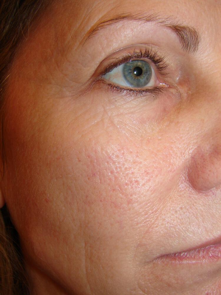 Laser Treatments Before & After Image