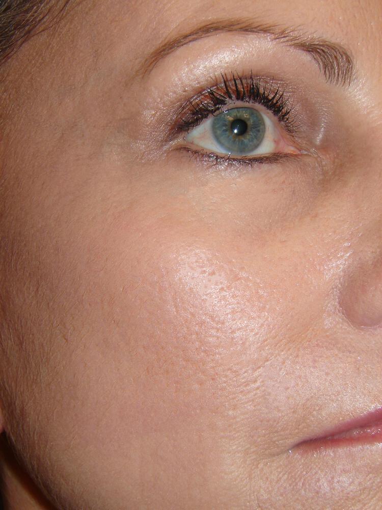 Laser Treatments Before & After Image