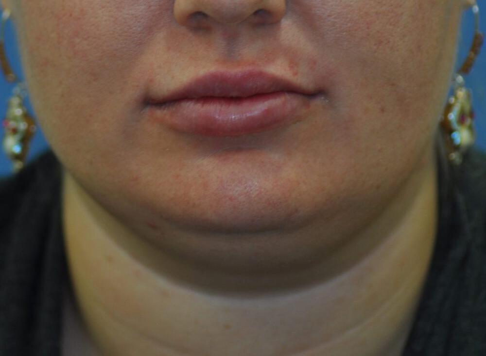 Lip Fillers Before & After Image