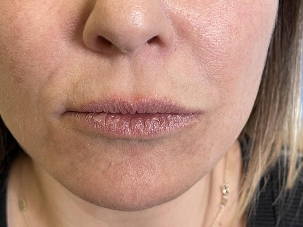 Lip Fillers Before & After Image