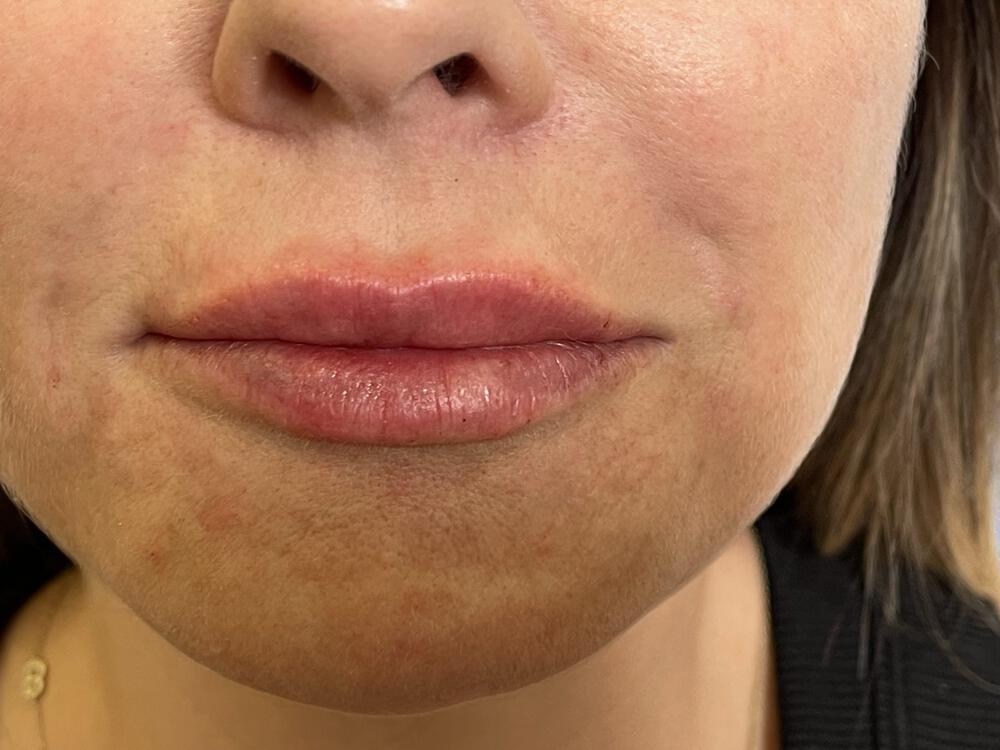 Lip Fillers Before & After Image